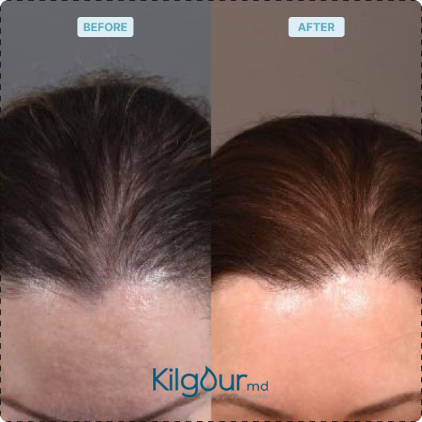 Participant scalp before and after treatment showing fuller hairline and increased density along the part