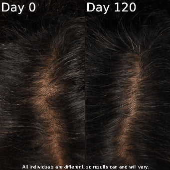Side-by-side comparison of hair density on Day 0 and Day 120 with text indicating individual variation.