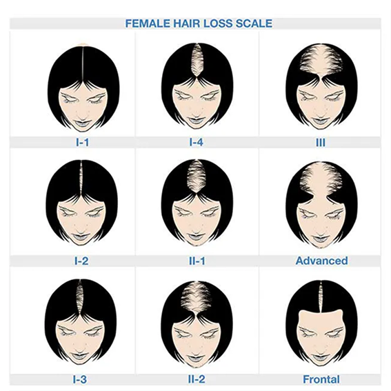 Diagram of female hair loss scale: nine head illustrations labeled I-1 to Frontal showing progression from part widening to crown thinning