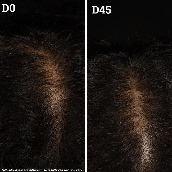 Top of scalp before and after treatment: Day 0 with a wide part and thinning hair, Day 120 with fuller hair and less visible scalp