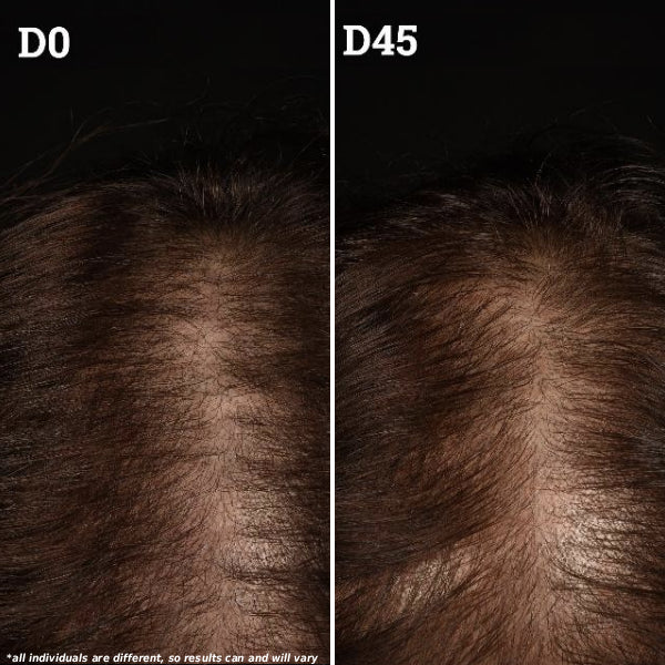 Top-down scalp photos comparing Day 0 and Day 120 showing increased hair density at the crown with overlaid labels Day 0 and Day 120