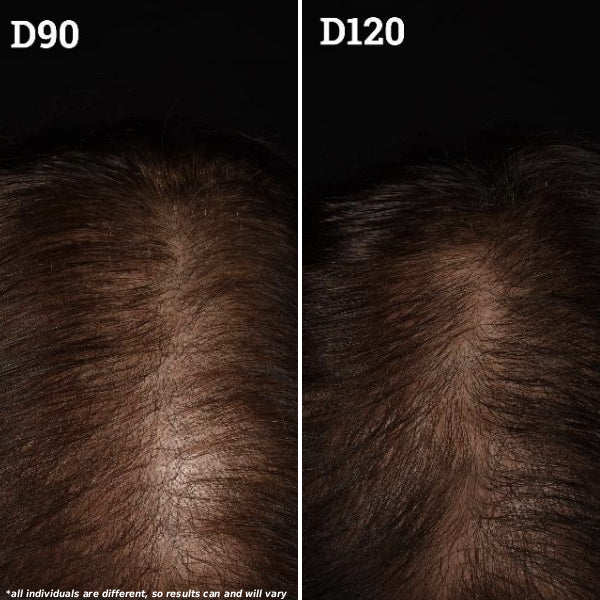 Side-by-side clinical photos labeled D90 and D120 showing reduced scalp visibility and increased hair density by Day 120